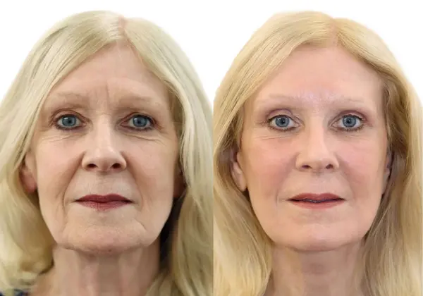 Before and after deep plane facelift and neck lift, patient in her 50s