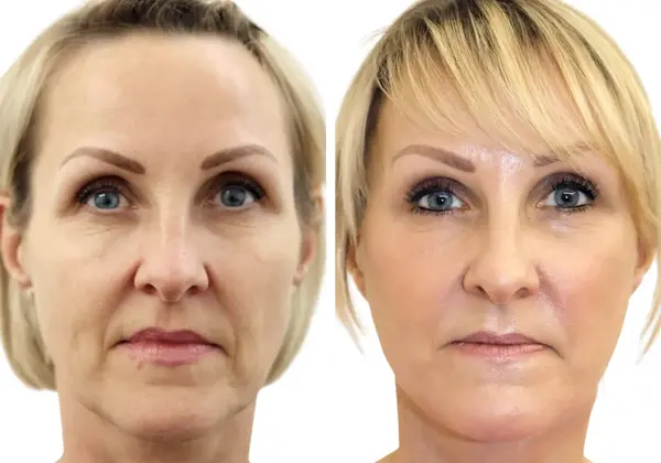 Before and after deep plane facelift, neck lift and eyelid surgery
