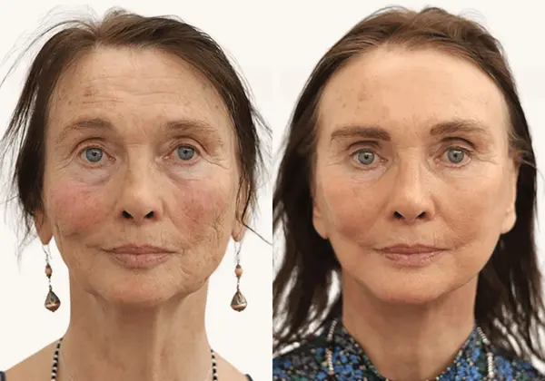 Before and after facelift, neck lift and fat transfer