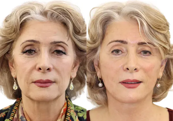 Facelift before and after by Dr Julian De Silva