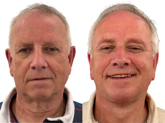 Male facelift before and after by Dr Julian De Silva, case 2