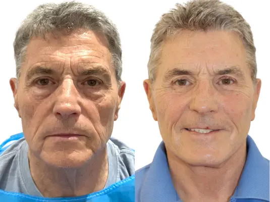 Male face and neck lift with eyelid surgery and cheek implants before and after, man in his seventies