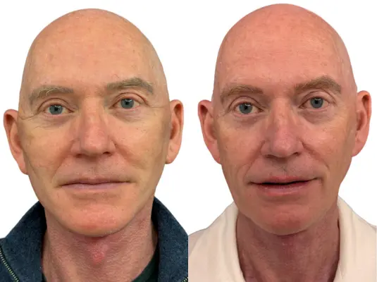 Male revision deep plane face and neck lift before and after, man in his early sixties
